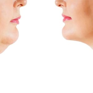 Know about these important reasons or causes for puffiness in the face!!