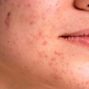 Various important reasons for getting chin acne, ways to manage etc!!