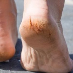 Effective Home Remedies to Treat Cracked Heels