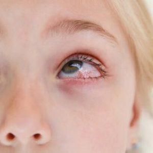 Eye Infection: Symptoms, Causes, Treatment & Prevention