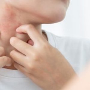 Heat Rash: What Is It and How to Get Quick Relief?