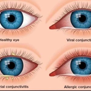 Madras Eye Prevention in Summer: Symptoms, Causes, and Safety Recommendations